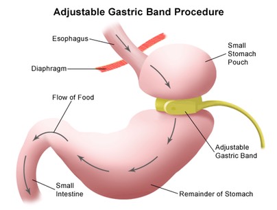 Virtual Gastric Band Hypnotherapy Diagram